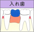 入れ歯