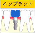 インプラント